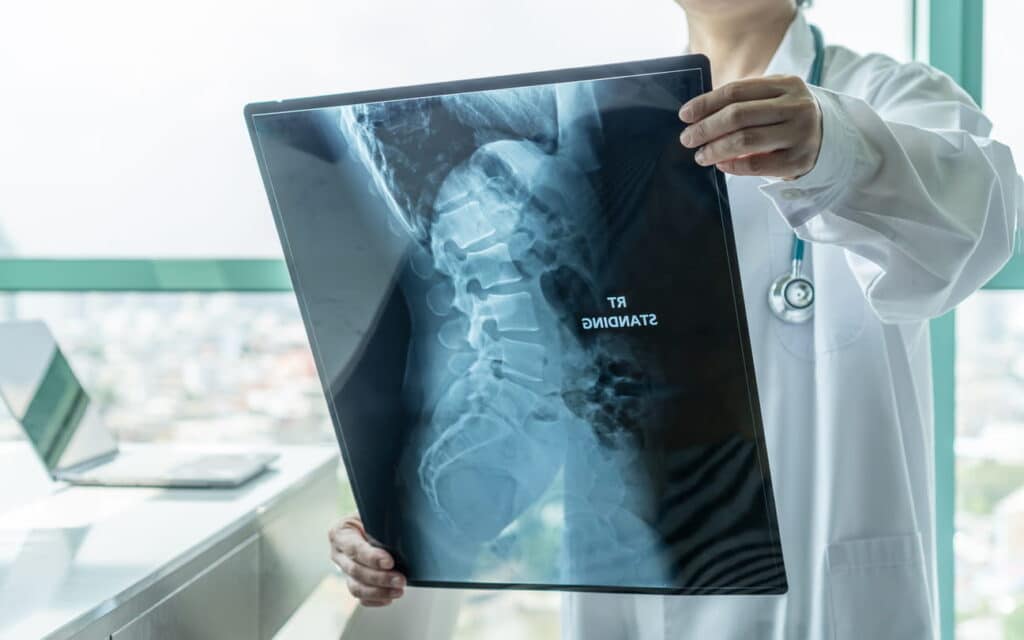 A doctor looking at a spinal X-ray for a spinal cord injury diagnosis.